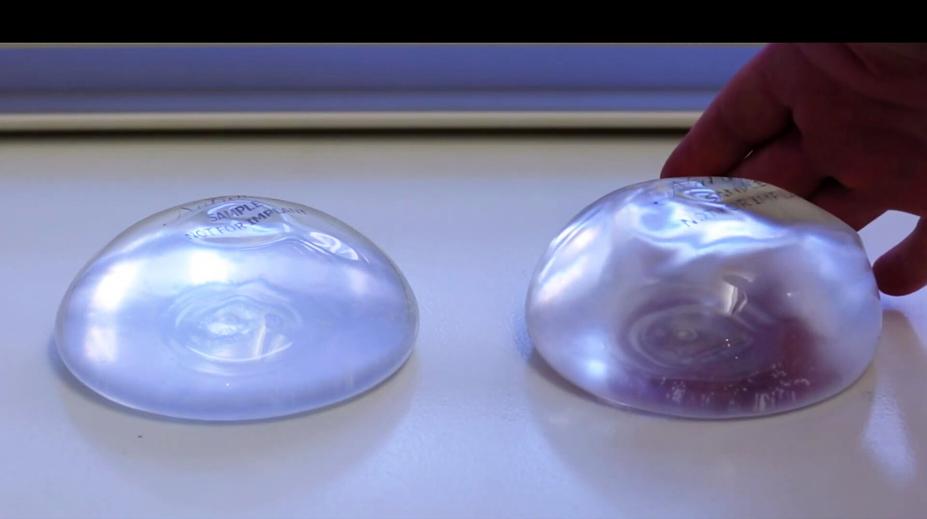 Přibývá žen s nemocí prsních implantátů. Pomohla až další operace, říkají