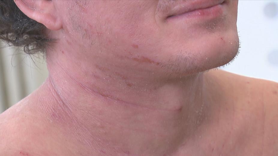 Dvouletý Čenda trpí od narození ekzémem. Pomoct může převratná léčba