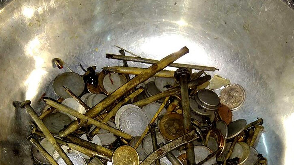 Muž měl v žaludku několik kilogramů železa