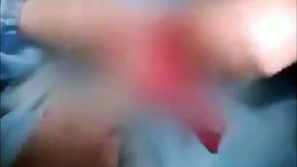 Muž si vrazil do penisu kabel - 2