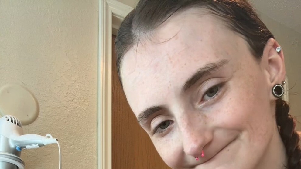 Žena přišla kvůli nedostatku vitamínů o všechny zuby