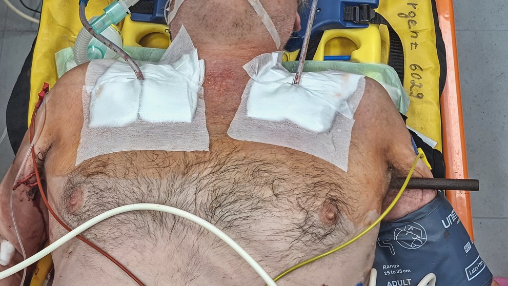 Muži hrudník propíchla kovová tyč (2)