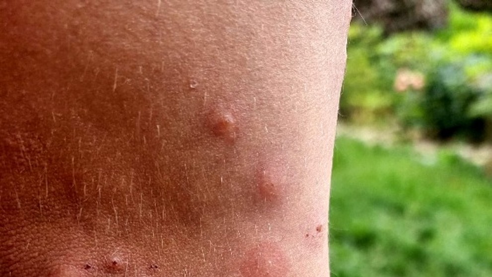 Štípance od štěnic (13)