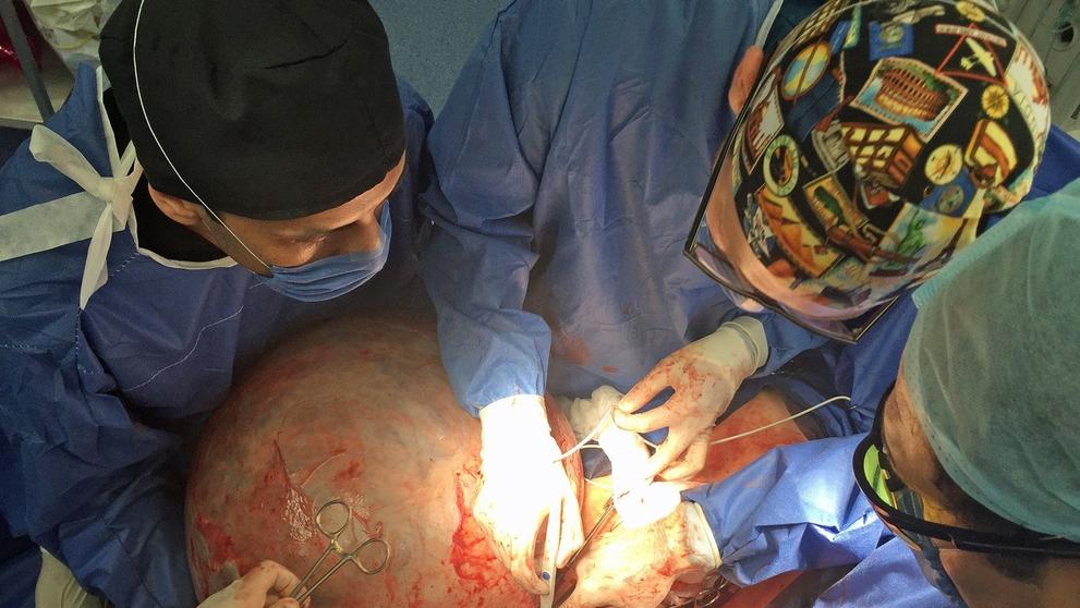 Lékaři ženě vyoperovali 33kilovou cystu - 2