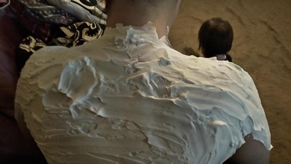 Žena našla lék na spáleniny od slunce - 3