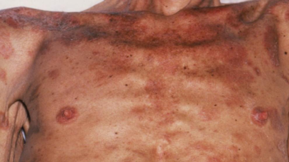 AIDS - 3