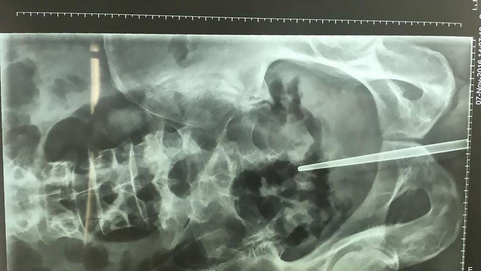 Muž si vrazil do penisu kabel - 1