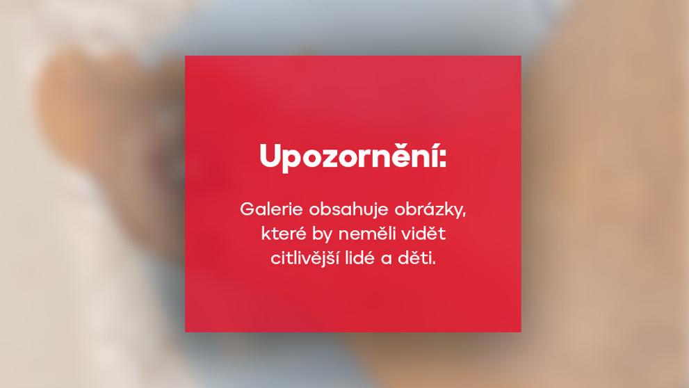 Sepse nohy - upozornění