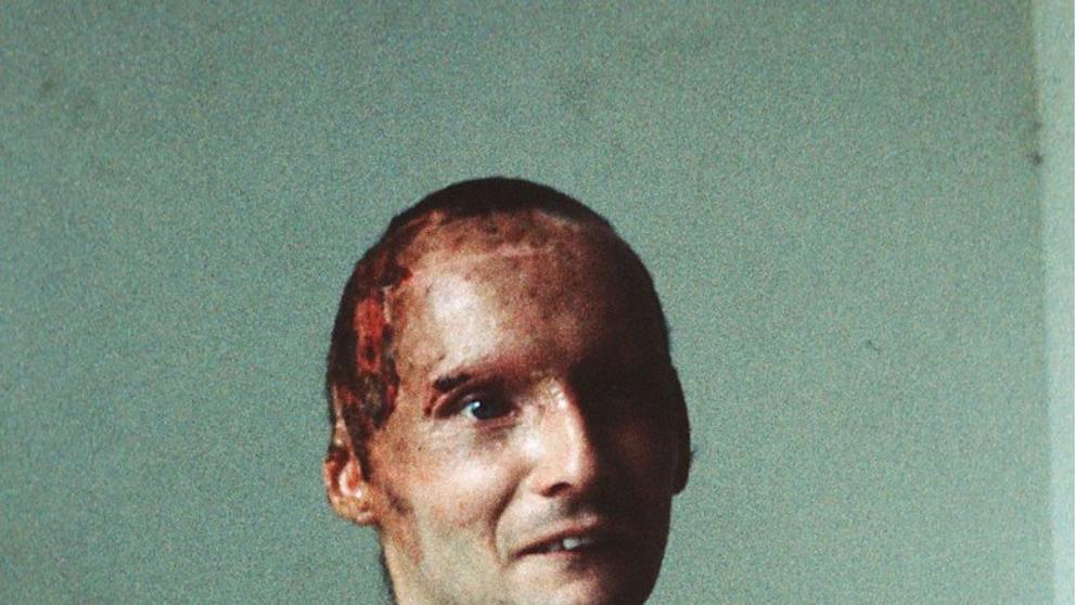 Niki Lauda po nehodě v roce 1976