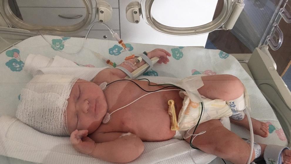 Při císařském řezu lékař pořezal hlavičku dítěte - 1