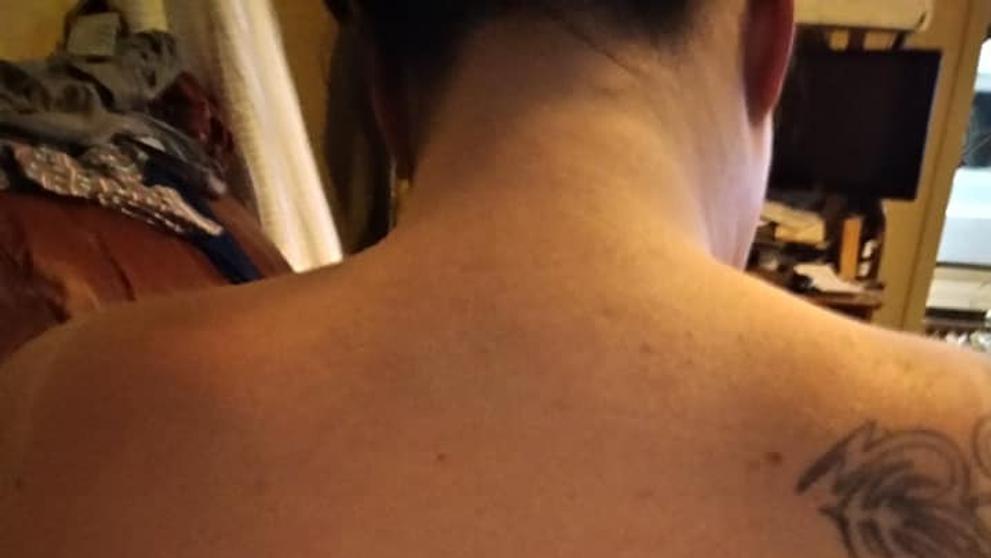 Žena našla lék na spáleniny od slunce - 2