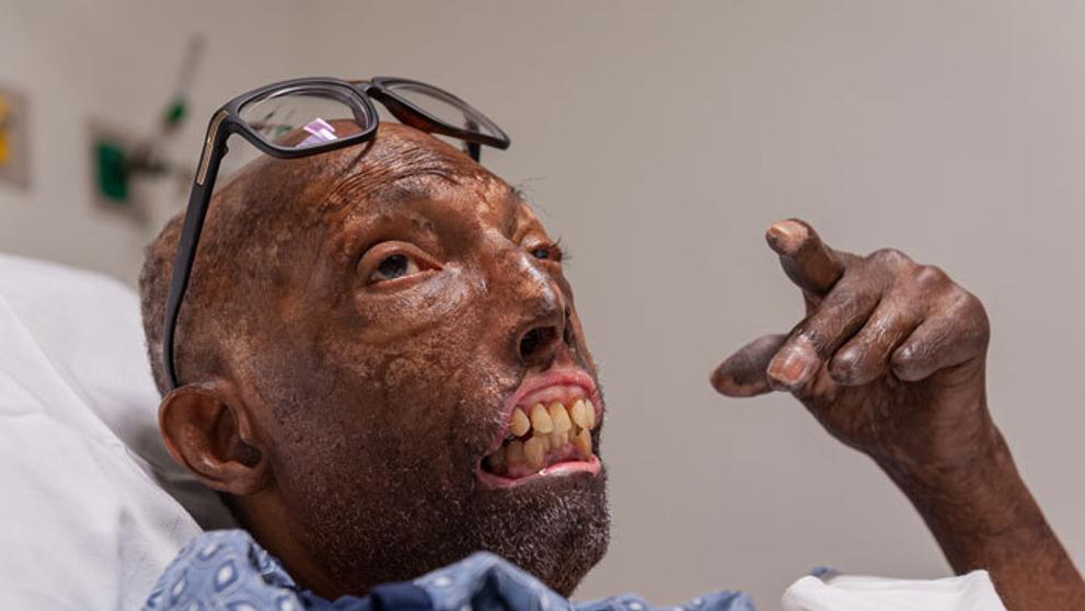 Transplantace obličeje Afroameričanovi - 2