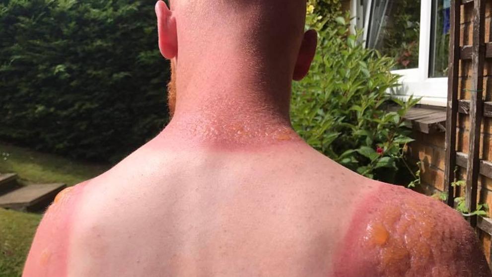 Zahradník utrpěl po sedmi hodinách na slunci popáleniny druhého stupně - 2
