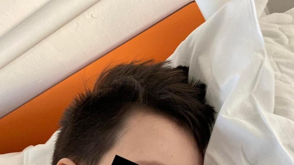 Otok tváře při neštovicích