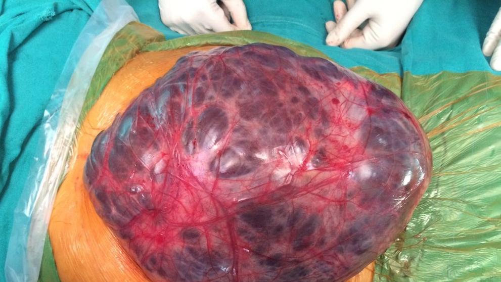 Ženě odstranili nádor vážící 7kg - 1