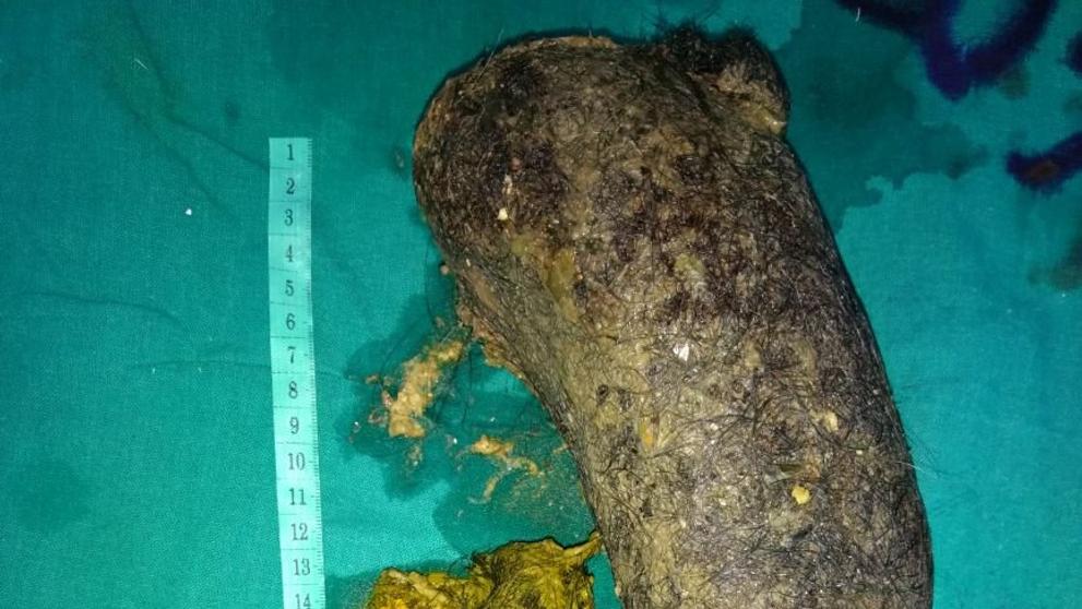 Ženě vyndali z žaludku 1,3 kilogramu vlasů