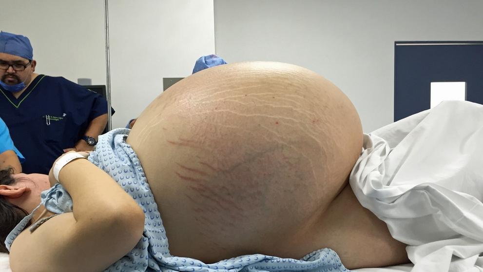 Lékaři ženě vyoperovali 33kilovou cystu - 1
