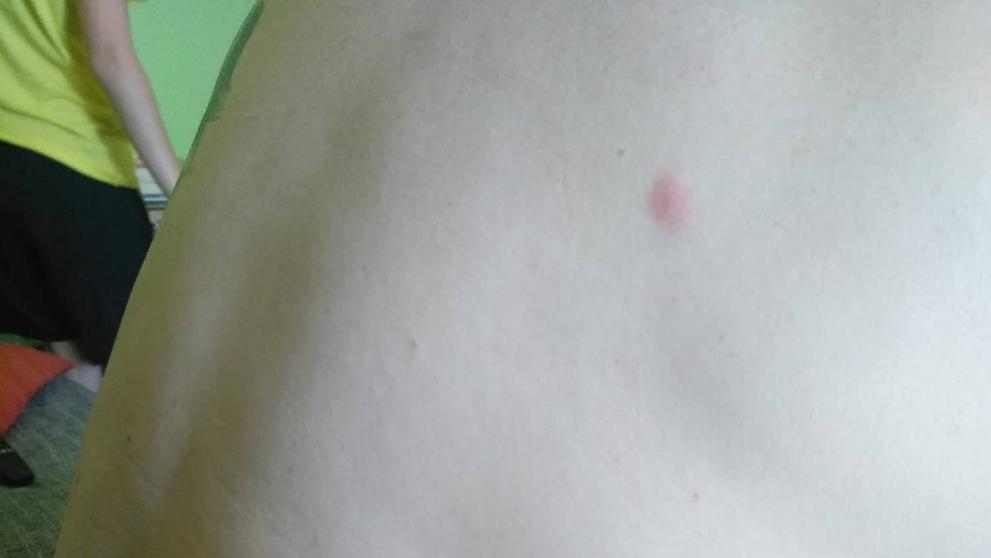 Muž má tělo plné kousanců od štěnic - 5