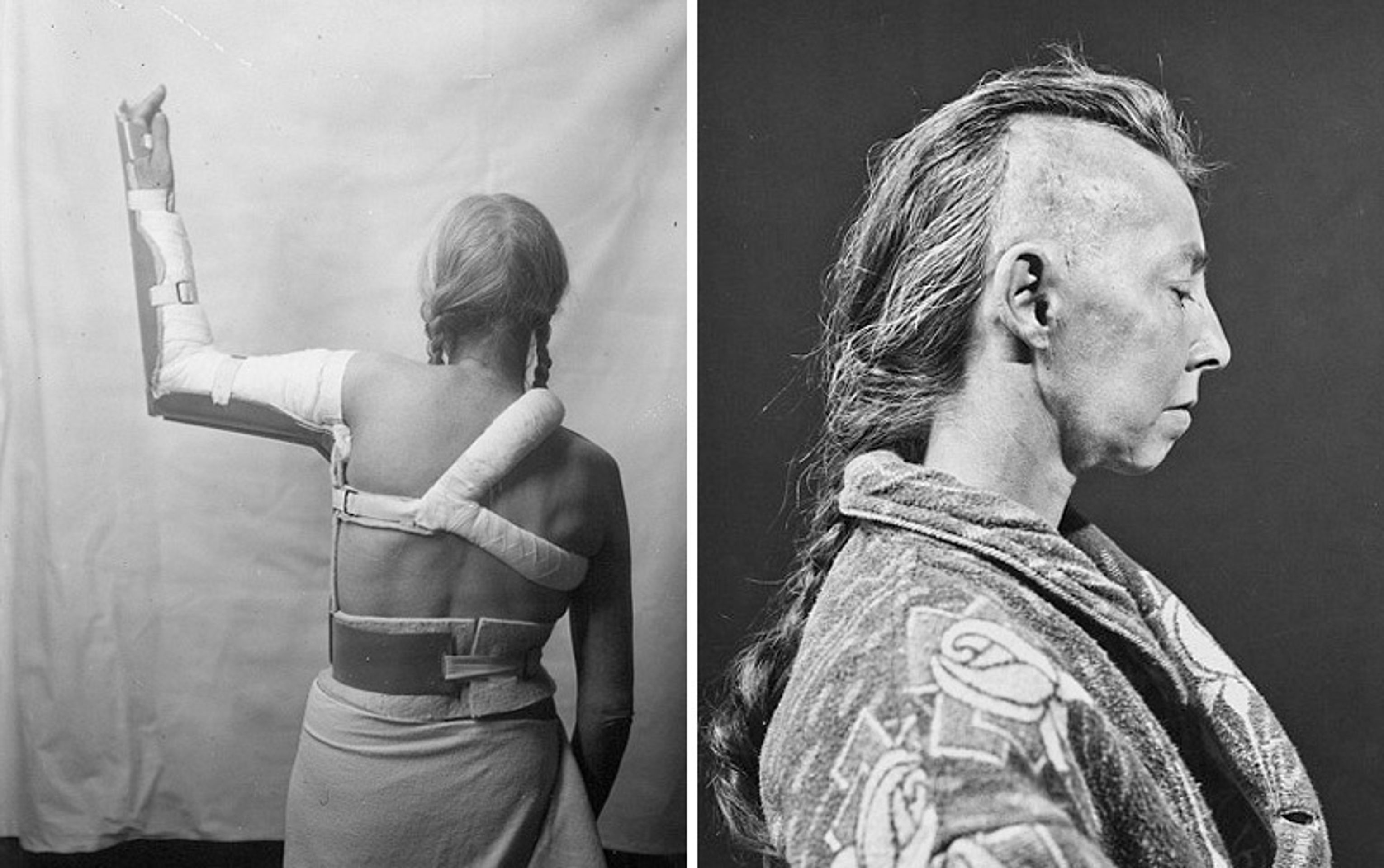 Operace mozku v historii - 6 - GALERIE: Šokující fotografie operací mozku (5/10)