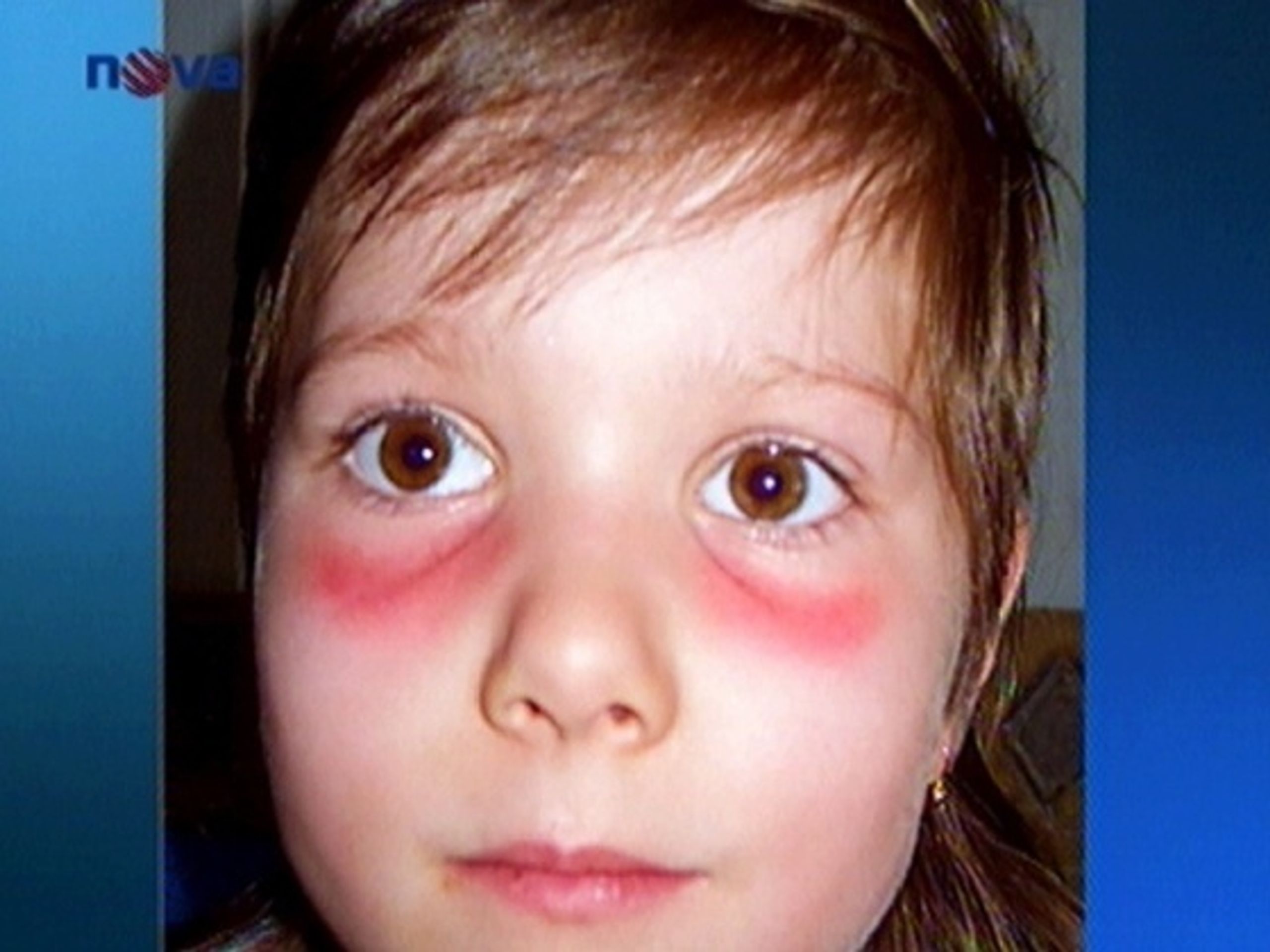 Dívka po použití dalekohledu. - Závadné dalekohledy vyvolávají alergii (1/2)