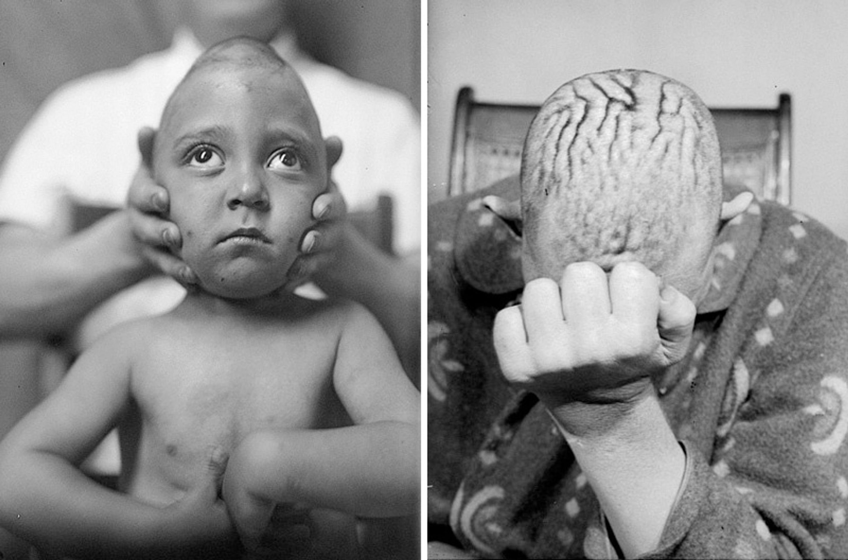 Operace mozku v historii - 1 - GALERIE: Šokující fotografie operací mozku (2/10)
