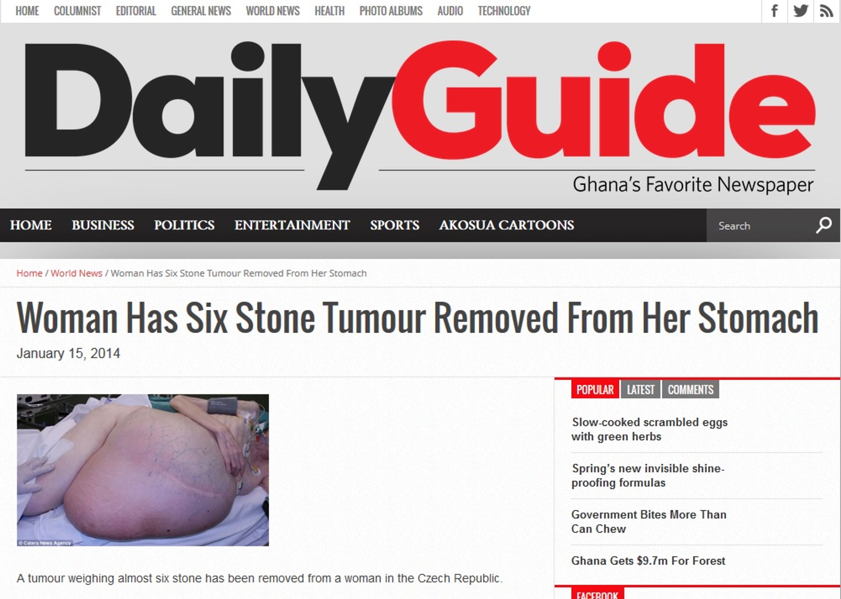 Obří nádor z Česka na DailyGuide - GALERIE: Obří nádor zaujal svět (4/4)