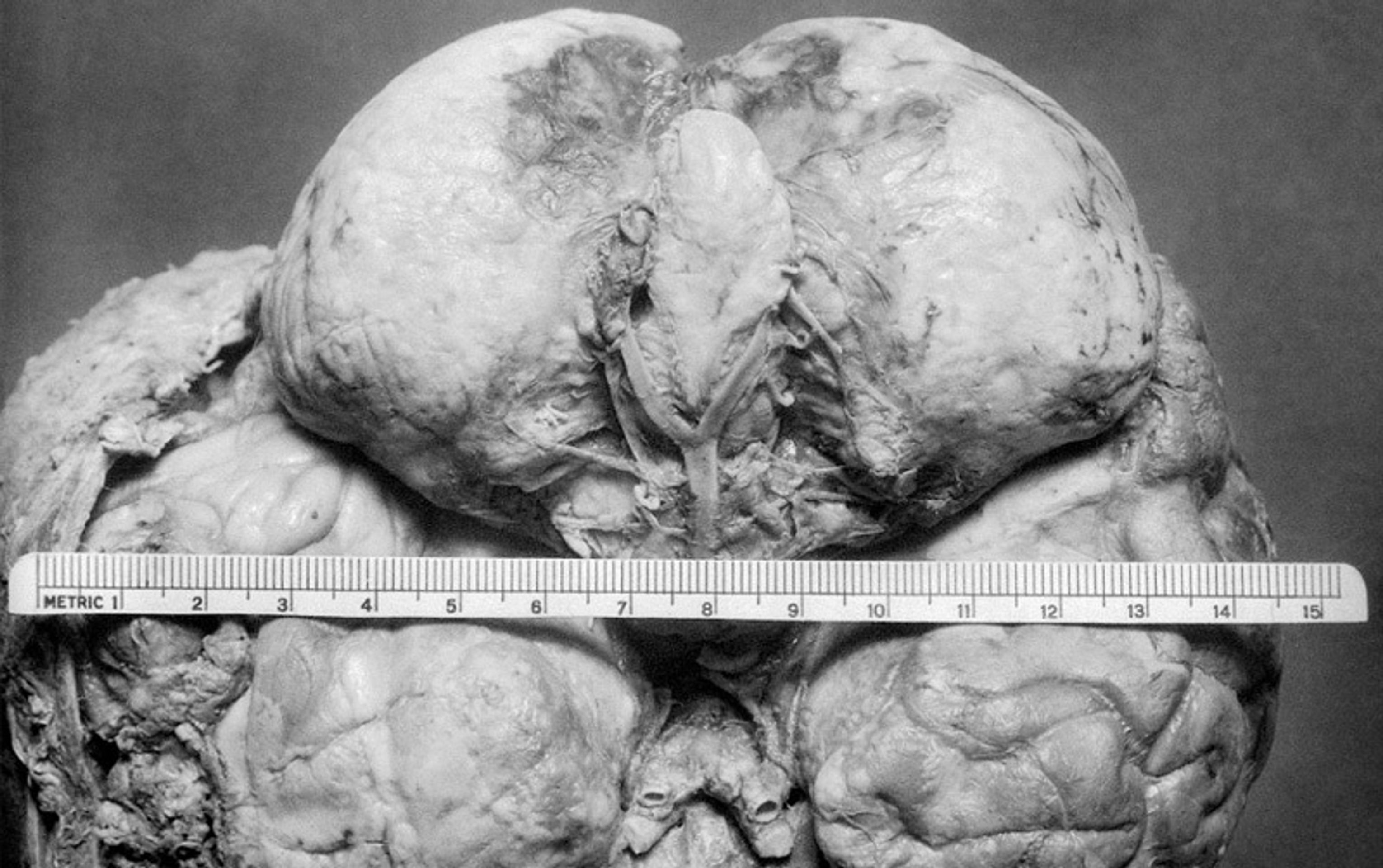 Operace mozku v historii - 2 - GALERIE: Šokující fotografie operací mozku (9/10)