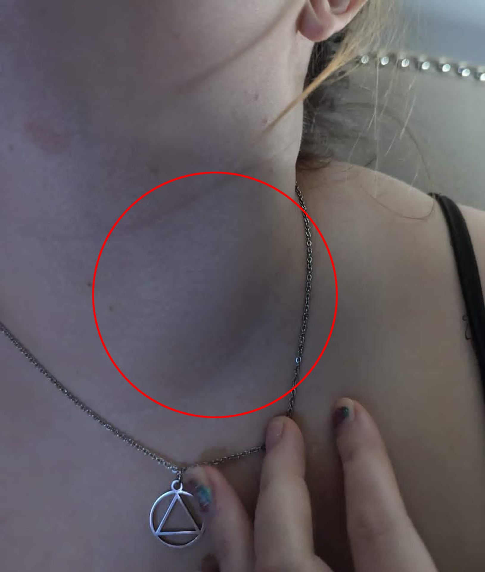 Pacientka Taylor Deanne Royová sdílí své příznaky rakoviny (5) - Pacientka Taylor Deanne Royová sdílí své příznaky rakoviny (2/5)