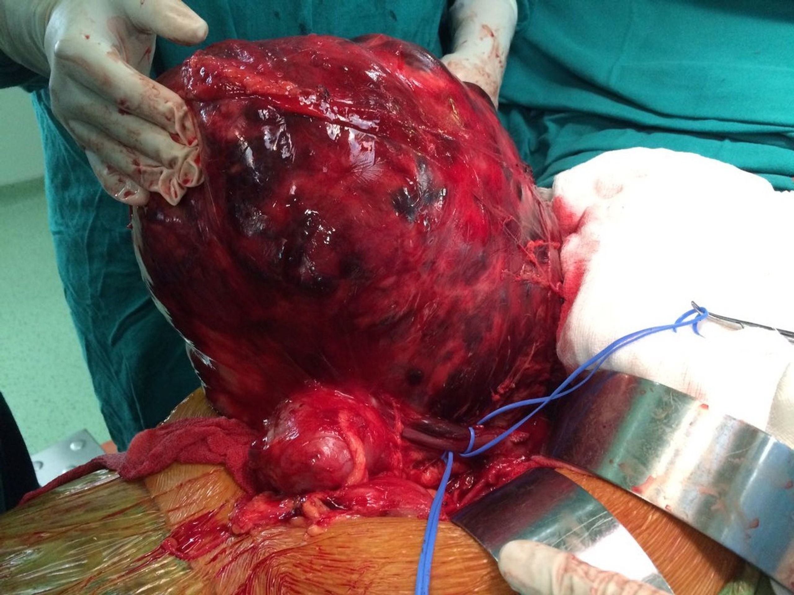 Ženě odstranili nádor vážící 7kg - 3 - GALERIE: Ženě odstranili nádor vážící 7kg (3/5)