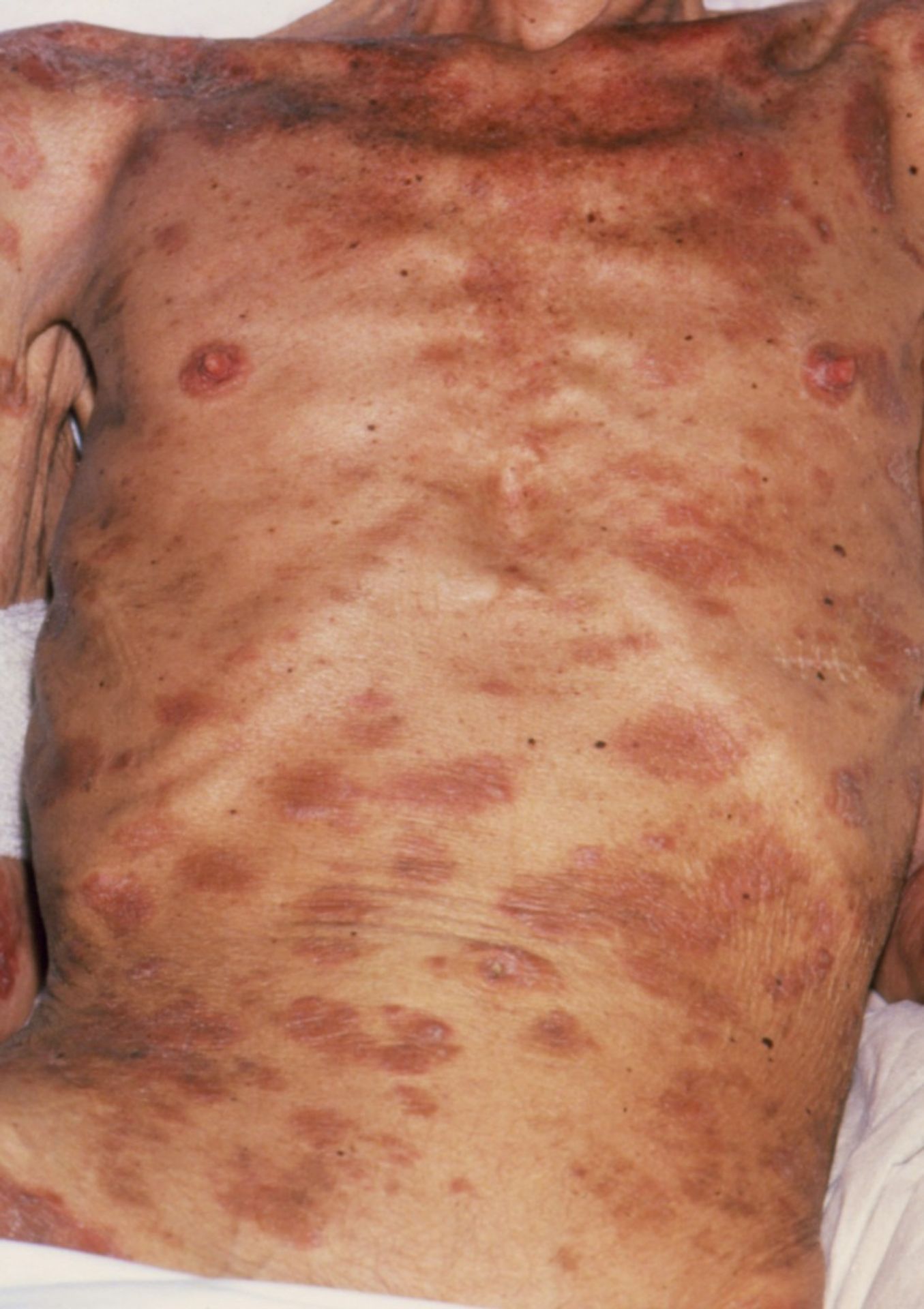 AIDS - 3 - GALERIE: AIDS (3/7)