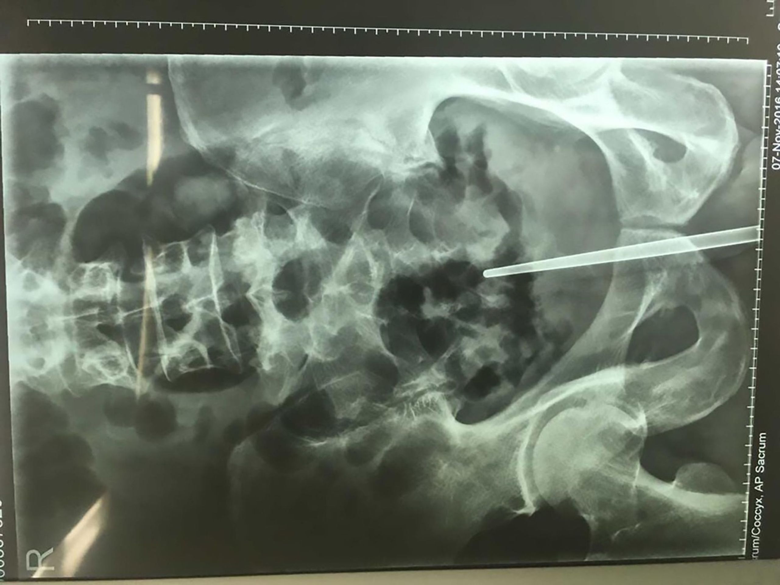 Muž si vrazil do penisu kabel - 1 - GALERIE: Muž si vrazil do penisu kabel (1/5)