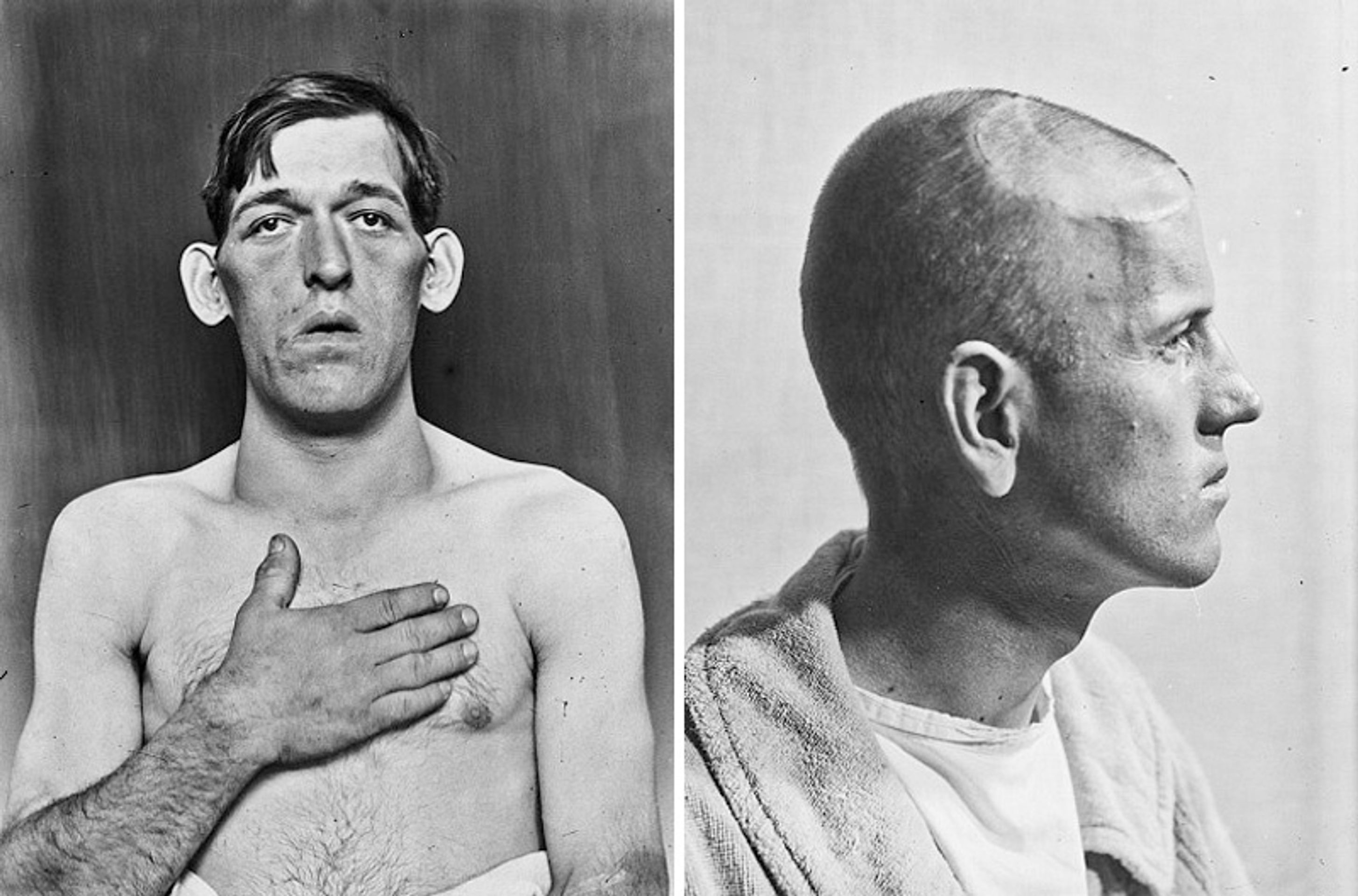 Operace mozku v historii - 3 - GALERIE: Šokující fotografie operací mozku (3/10)