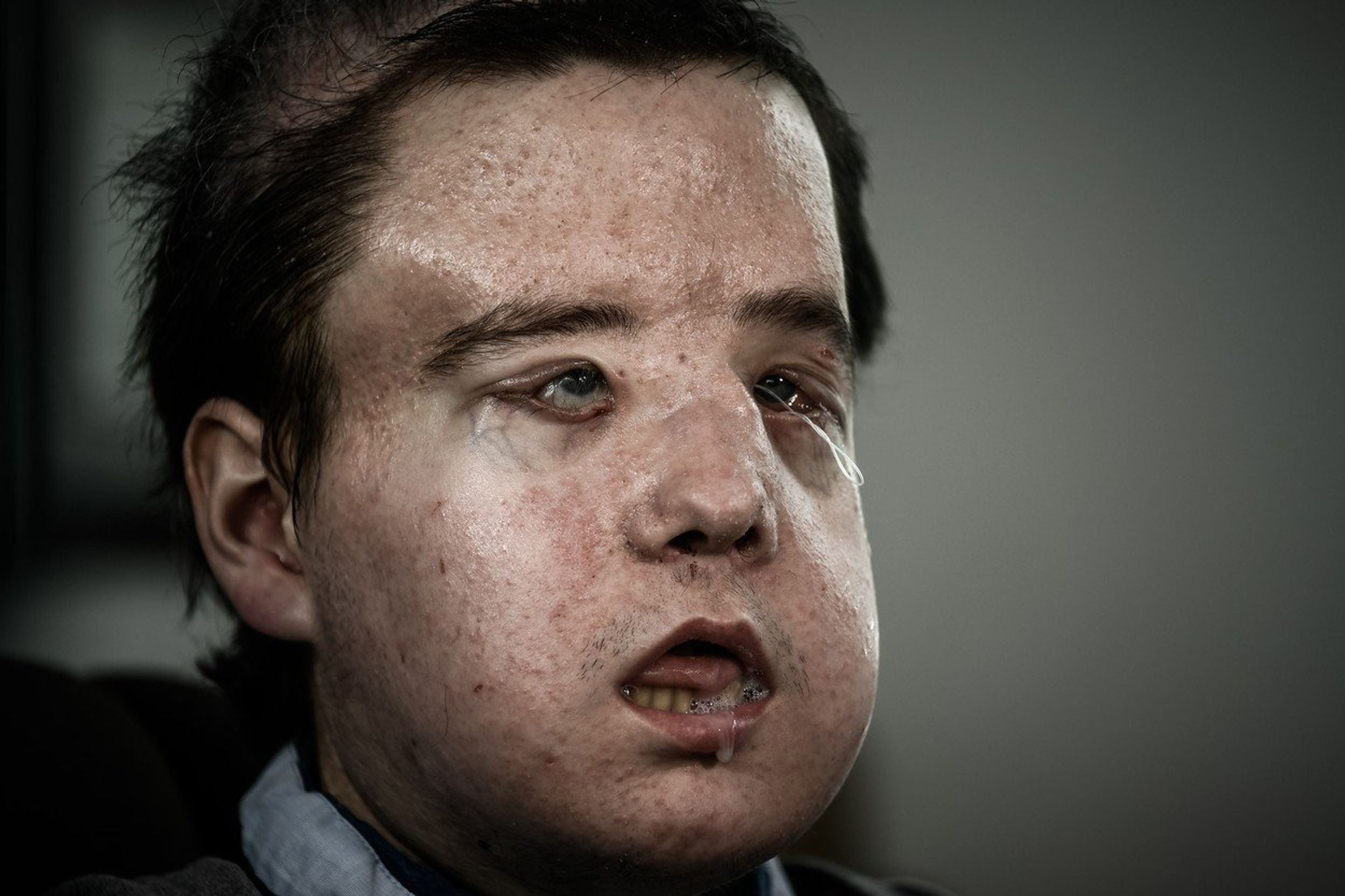 Muž po druhé transplantaci obličeje - GALERIE: Muž je po druhé transplantaci obličeje (5/5)