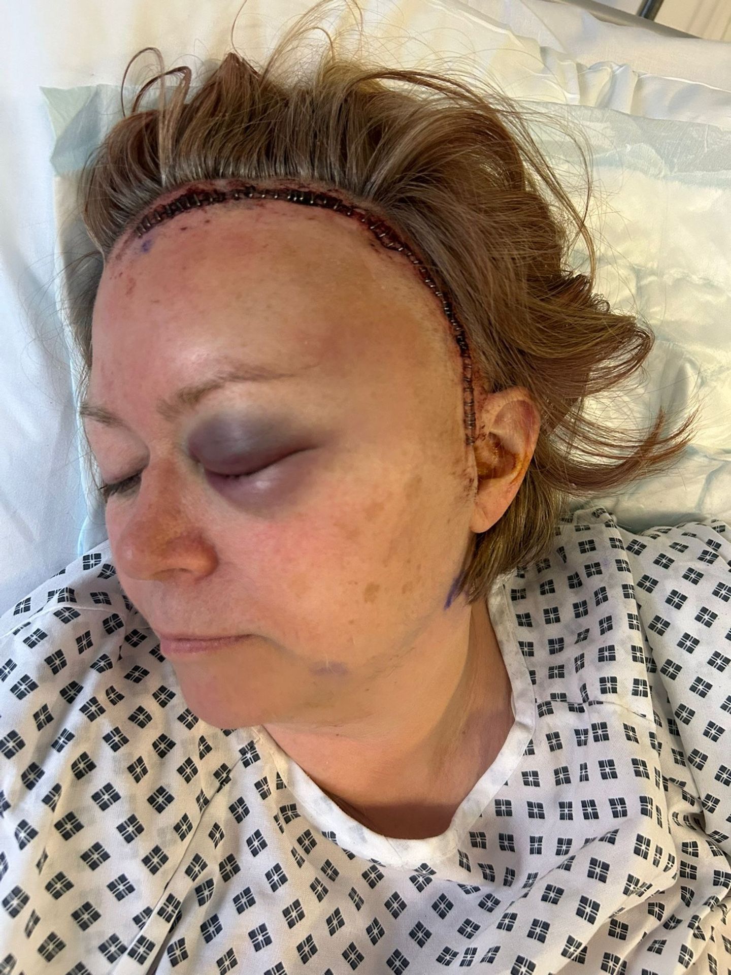 Prasklé aneurysma, operace - Prasklé aneurysma, operace (5/6)