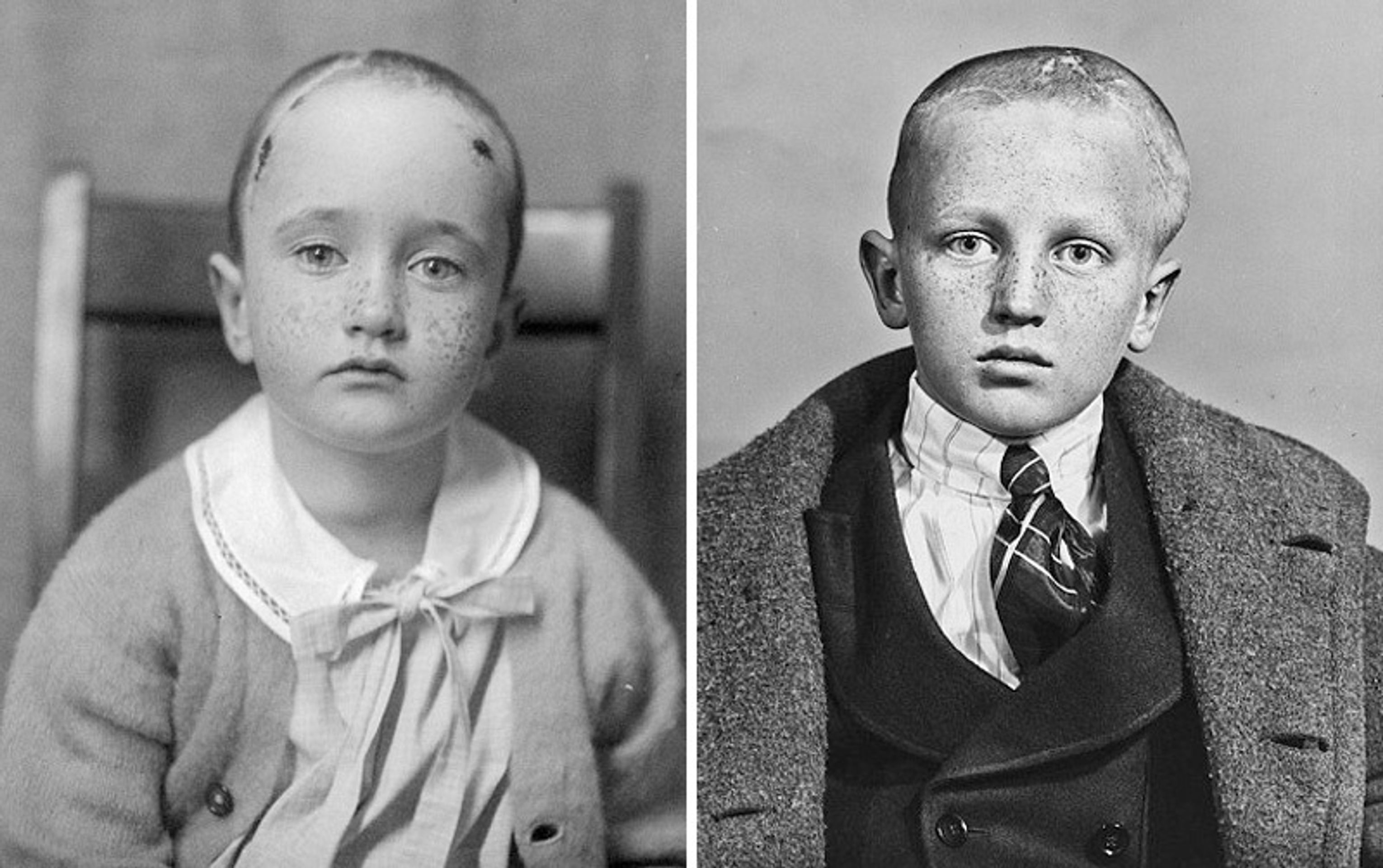 Operace mozku v historii - 9 - GALERIE: Šokující fotografie operací mozku (10/10)