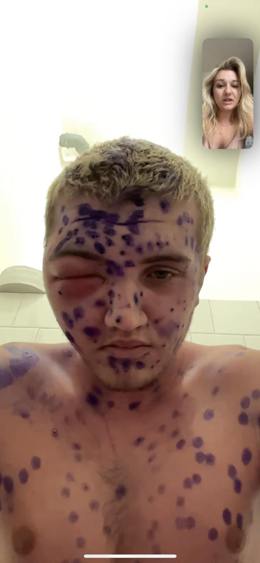 Tomáš - Neštovice dostaly Tomáše na vozík (2/3)