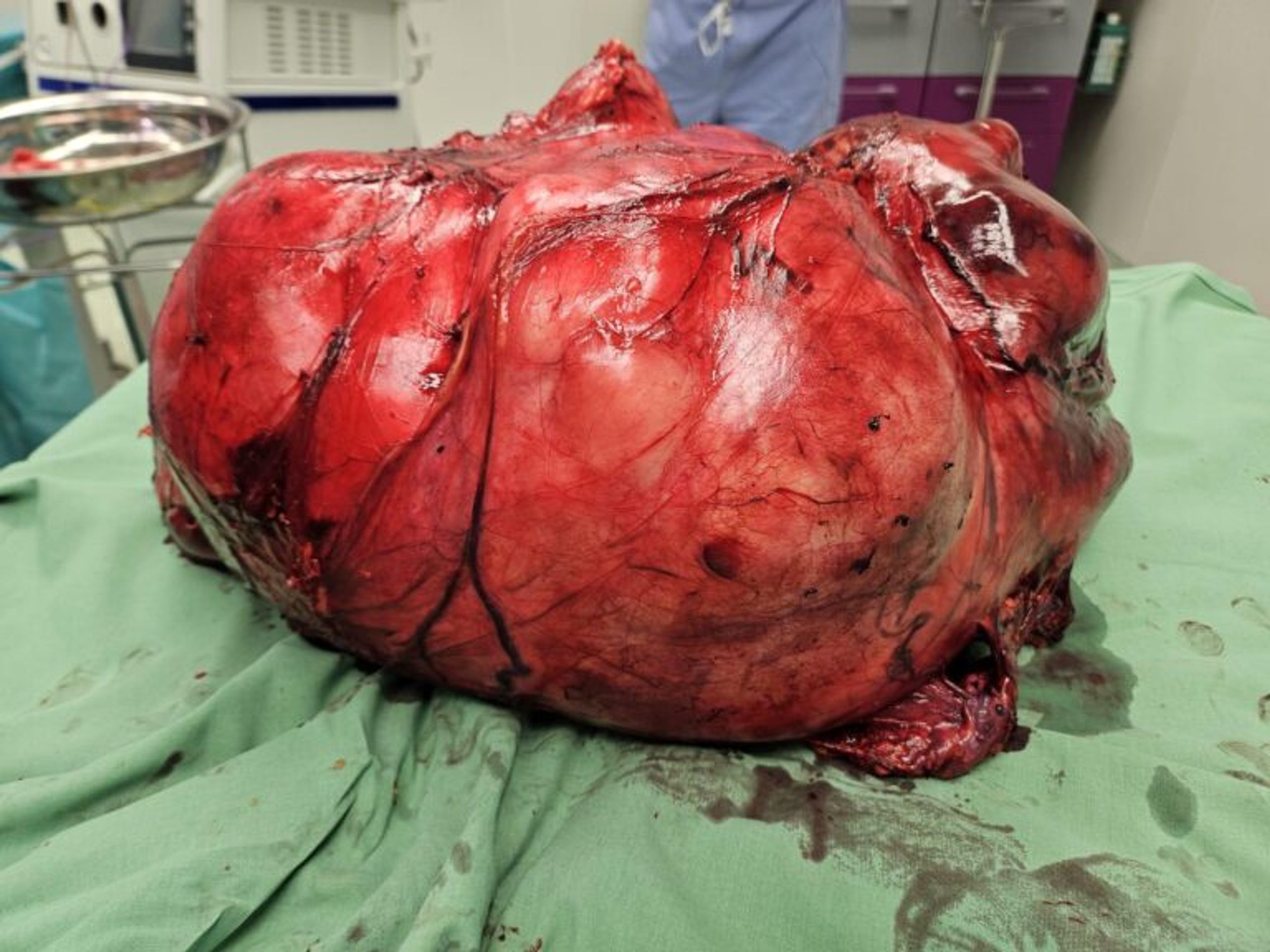 Lékaři pacientce úspěšně odstranili 19 kg těžký nádor - Lékaři pacientce úspěšně odstranili 19 kg těžký nádor (5/5)