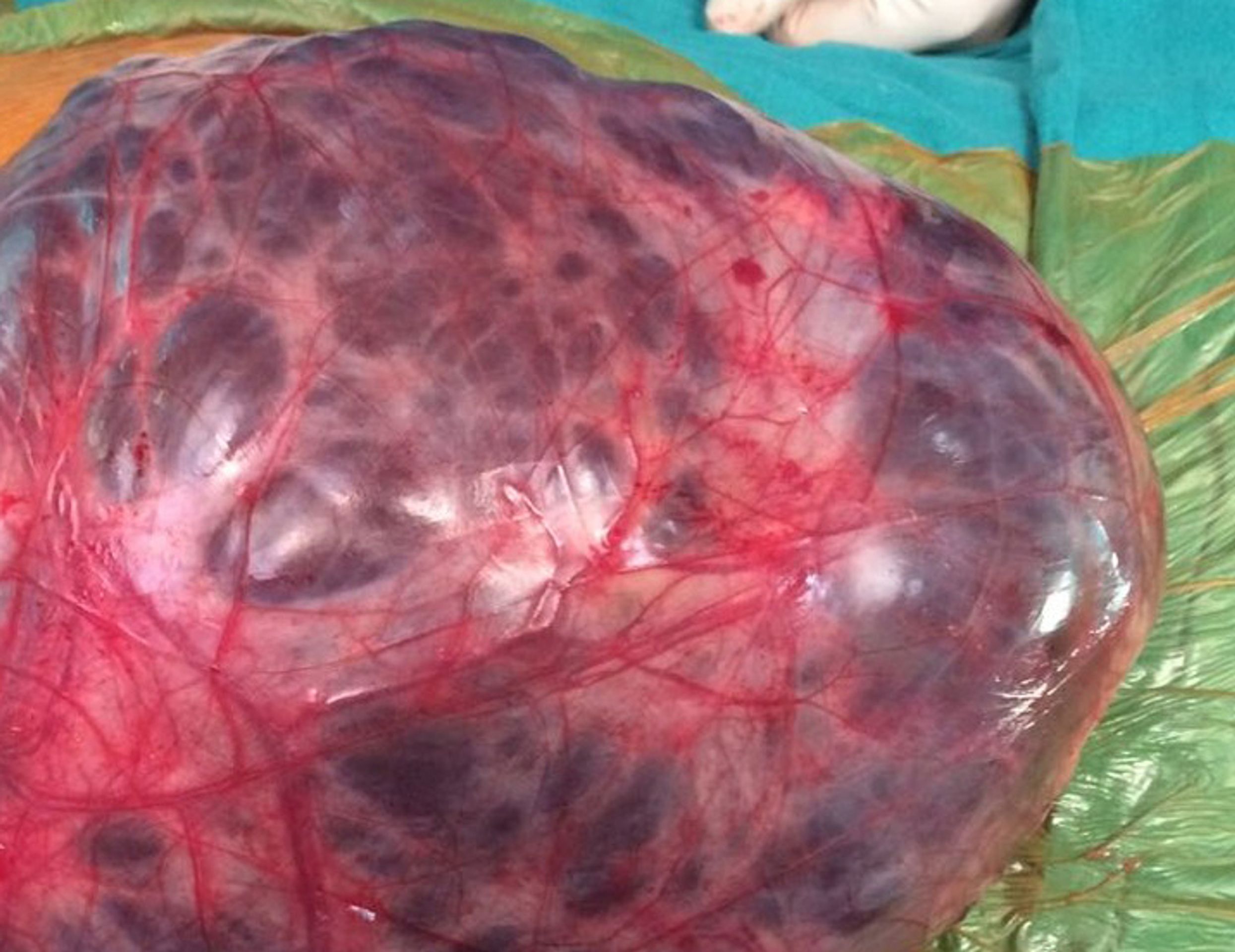 Ženě odstranili nádor vážící 7kg - 5 - GALERIE: Ženě odstranili nádor vážící 7kg (5/5)