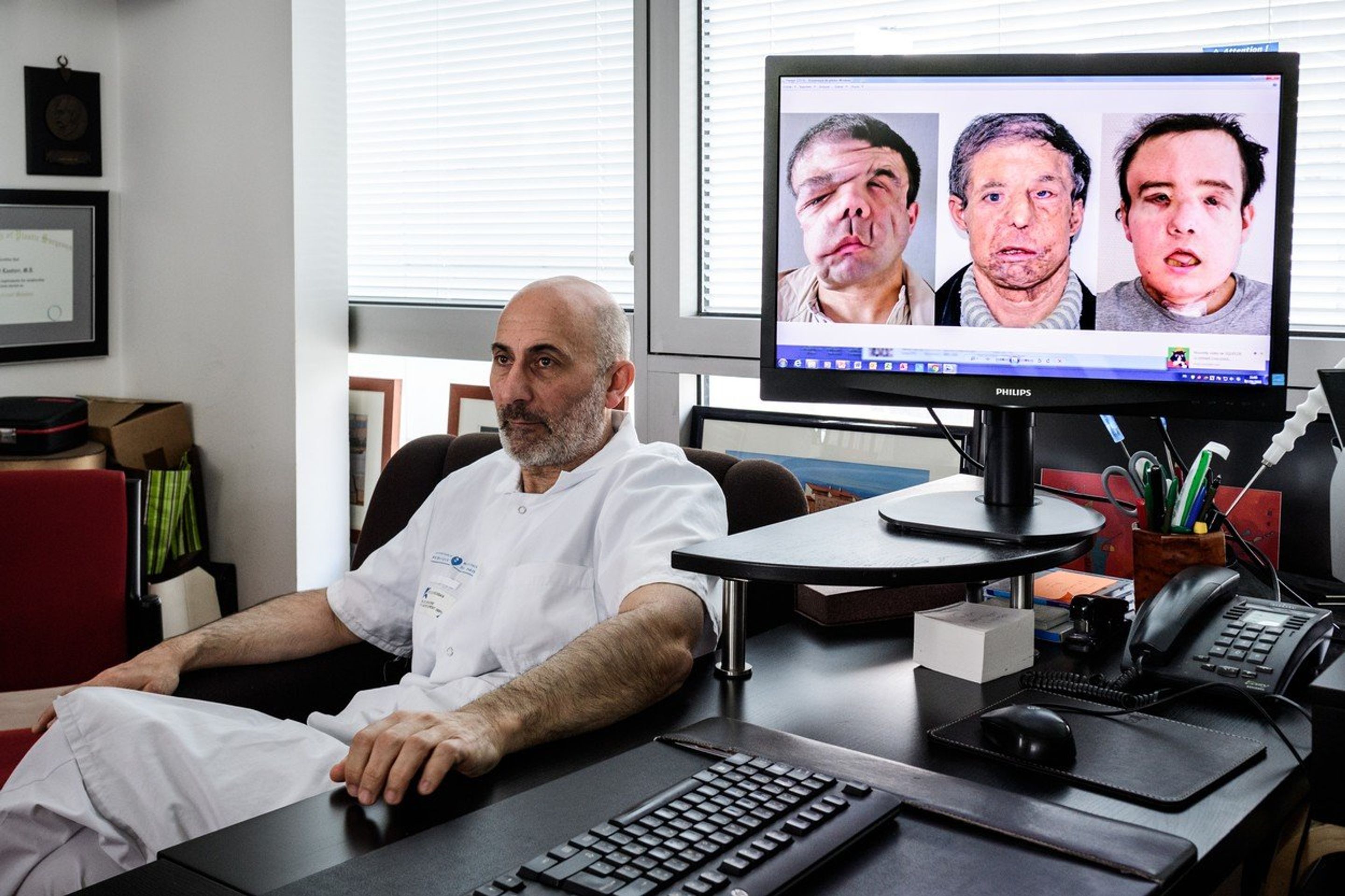 Muž po druhé transplantaci obličeje - GALERIE: Muž je po druhé transplantaci obličeje (1/5)