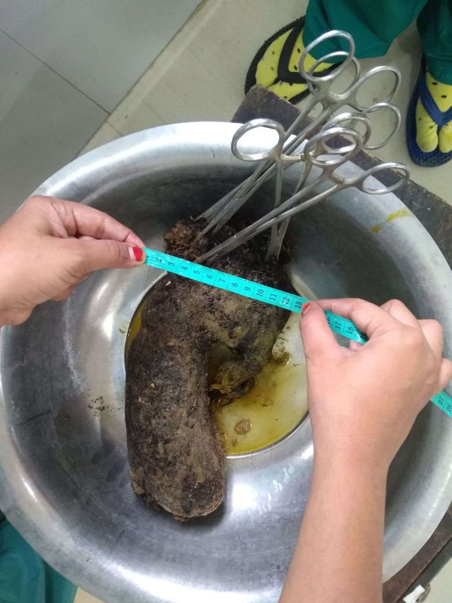 Ženě vyndali z žaludku 1,3 kilogramu vlasů - GALERIE: Lékaři vyndali ženě z žaludku přes kilo vlasů, muži kila železa (4/4)