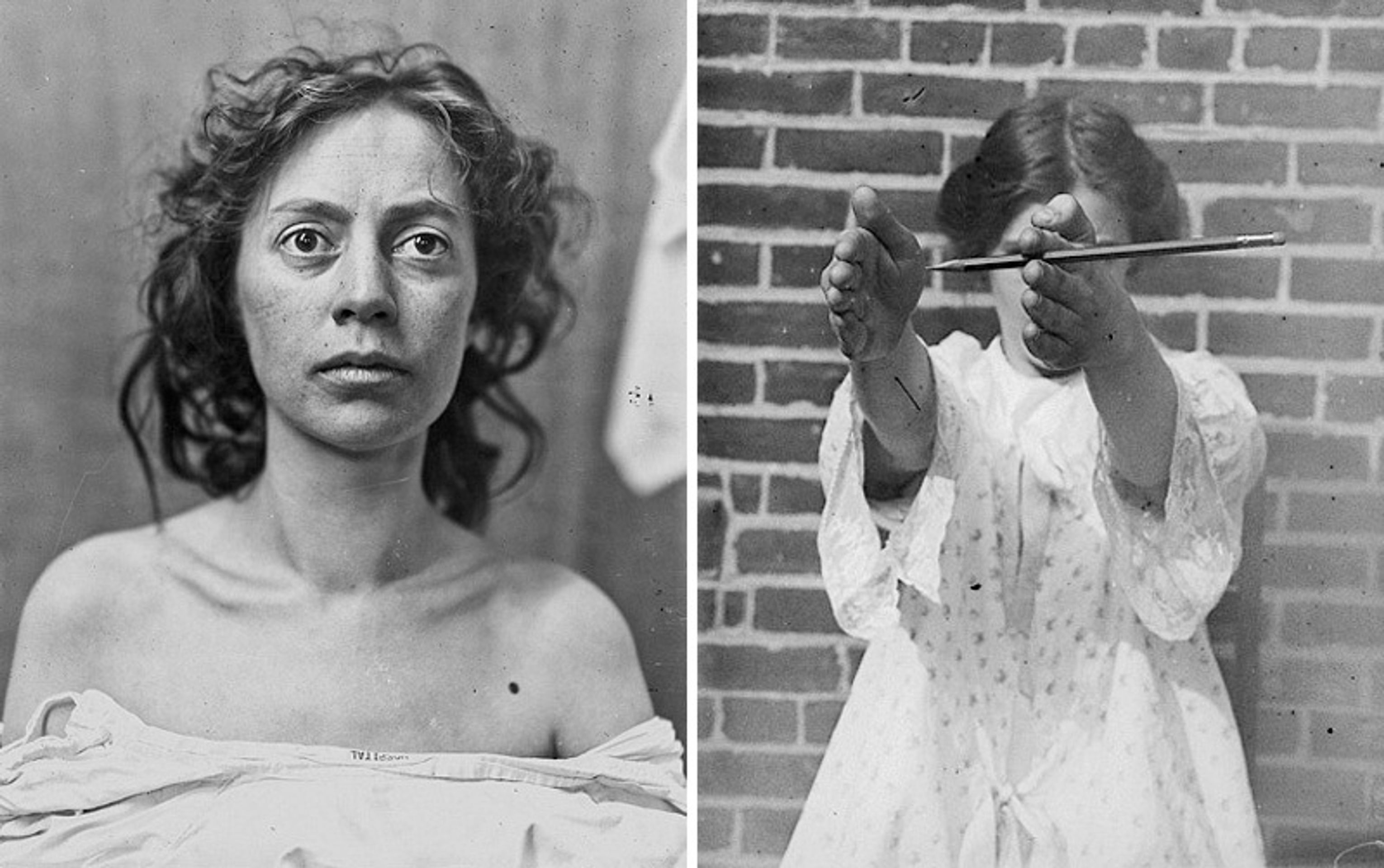 Operace mozku v historii - 8 - GALERIE: Šokující fotografie operací mozku (8/10)