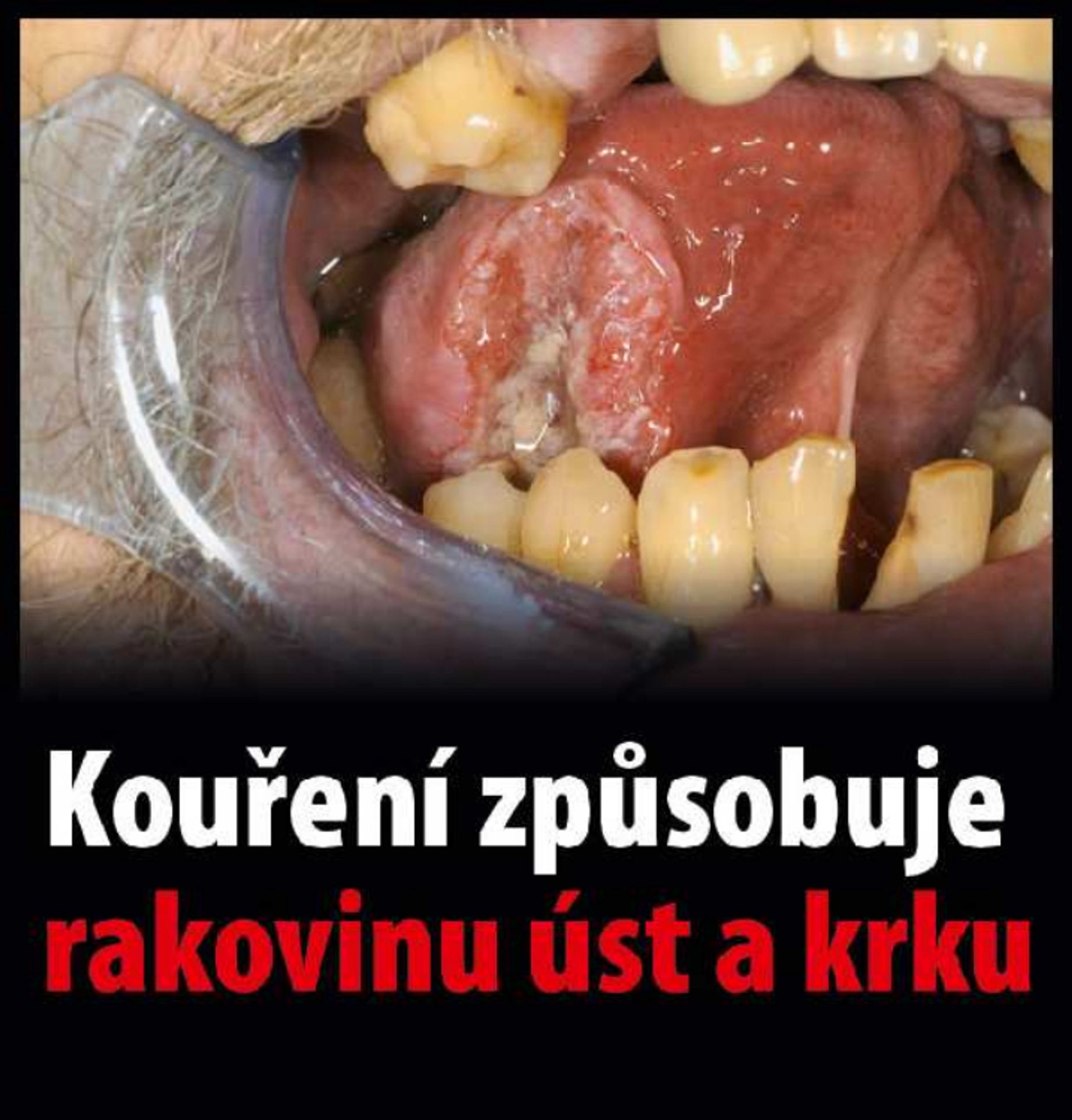 Varovné obrázky na krabičkách cigaret - 24 - GALERIE: Varovné obrázky na krabičkách cigaret (24/42)