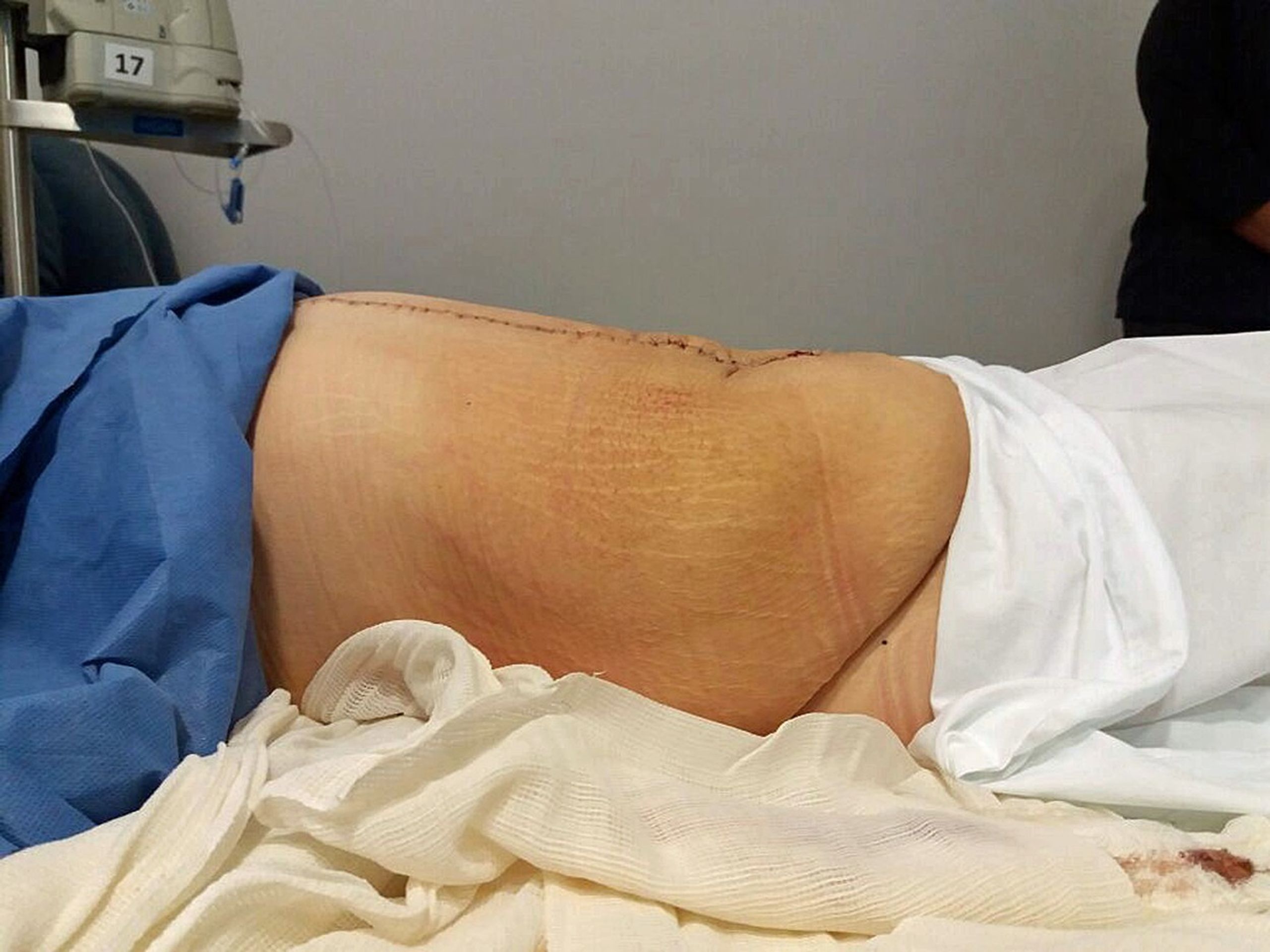 Lékaři ženě vyoperovali 33kilovou cystu - 5 - GALERIE: Lékaři ženě vyoperovali 33kilový nádor (5/5)