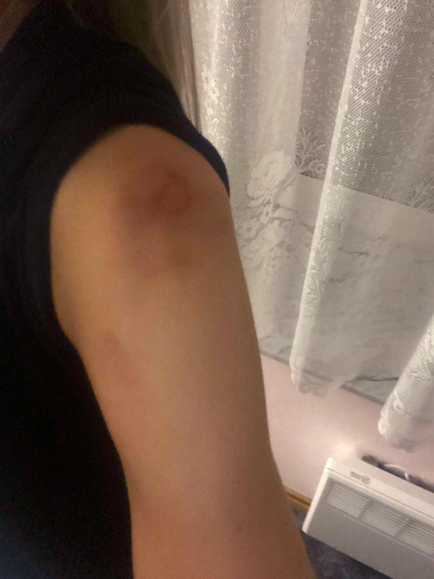 Pohmožděniny na ruce Vanessy - Rodina Vanessy (4/5)
