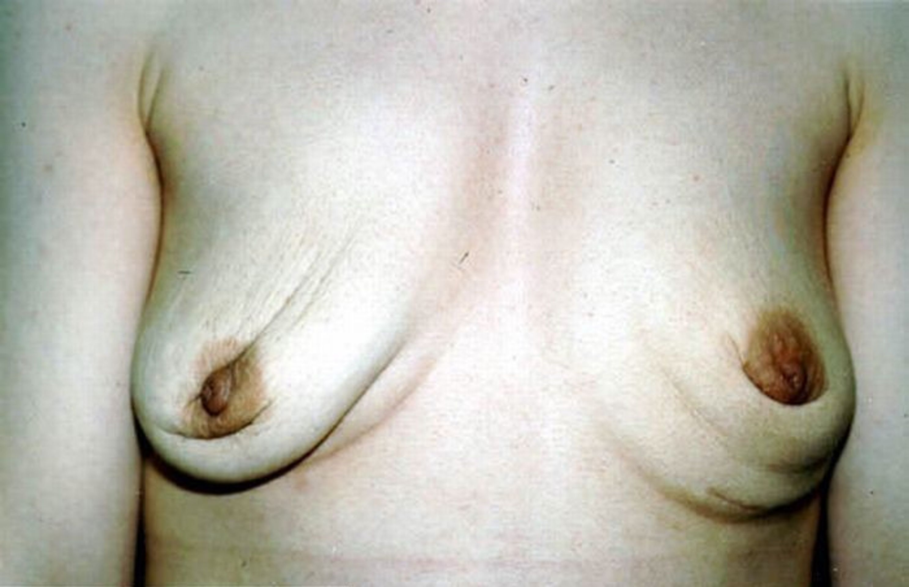 Ošklivá prsa - 9 - GALERIE: Ošklivá prsa (9/11)