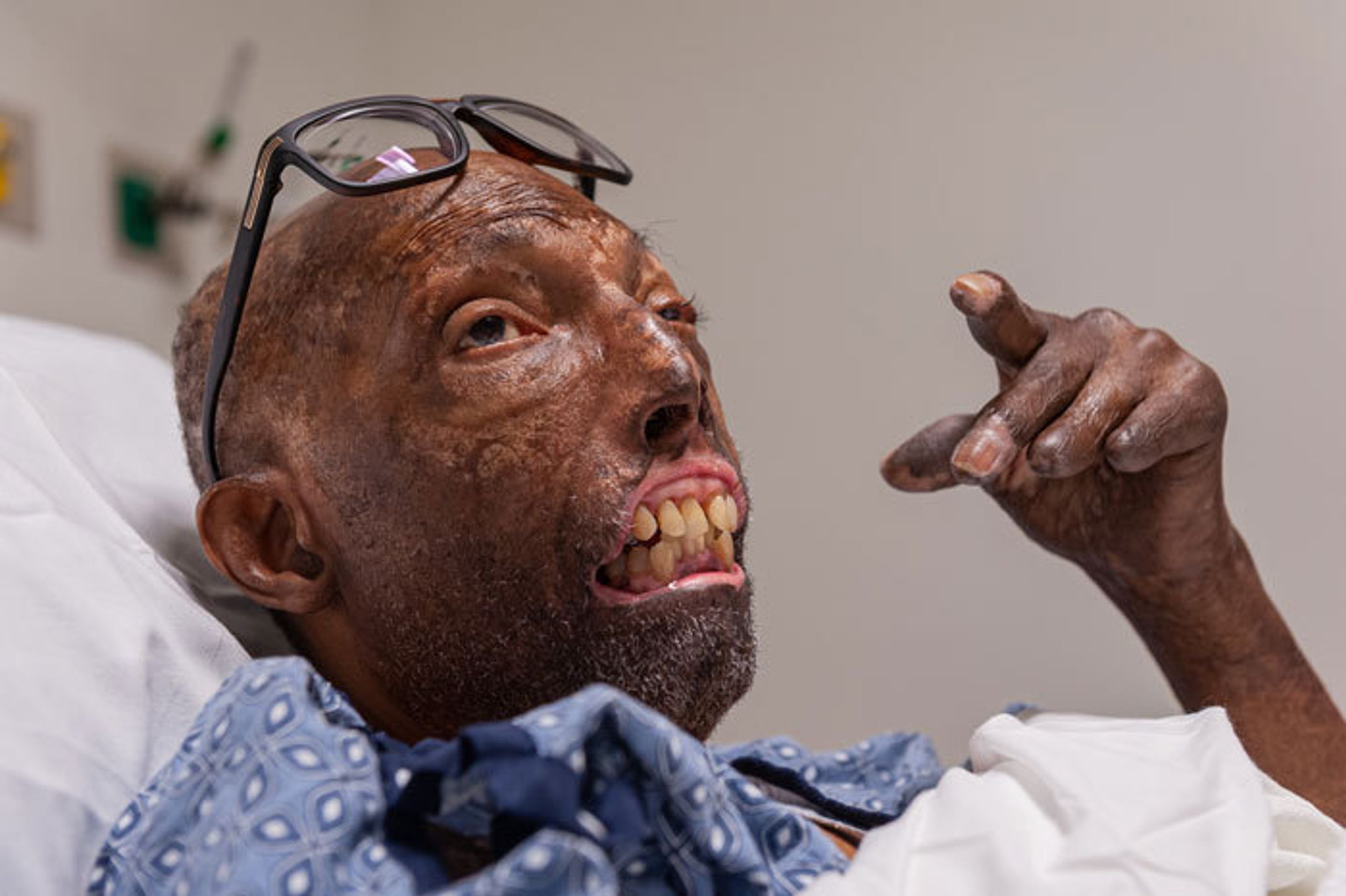 Transplantace obličeje Afroameričanovi - 2 - GALERIE: Transplantace obličeje prvnímu Afroameričanovi (1/5)