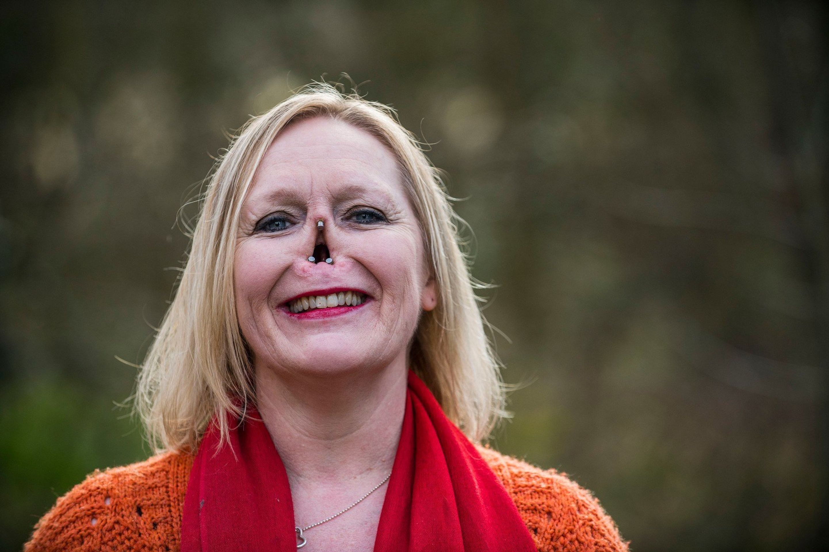 Žena nemá nos, musí nosit protézu - 4 - GALERIE: Žena nemá nos, musí nosit protézu (1/4)