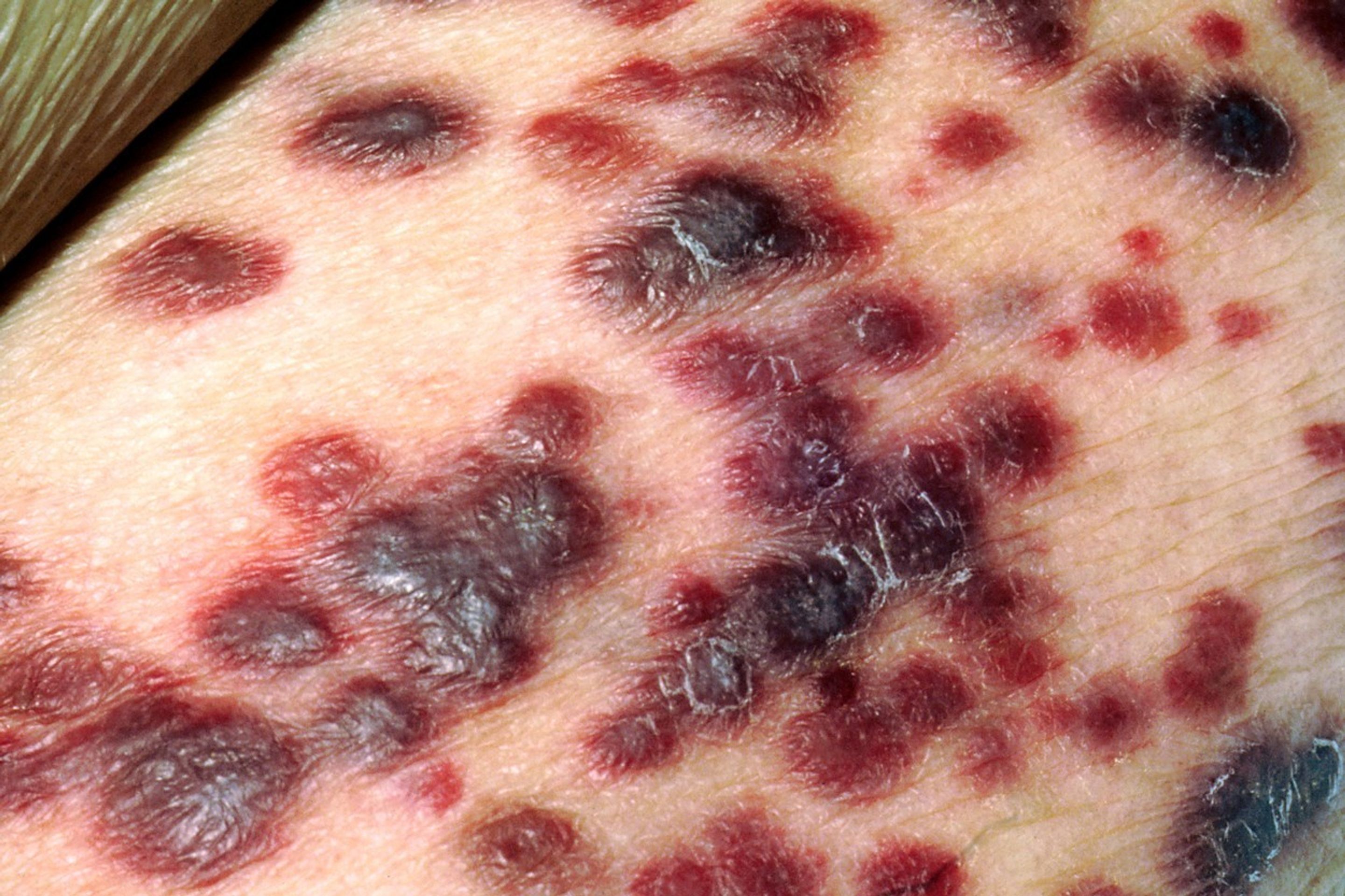 AIDS - 5 - GALERIE: AIDS (5/7)