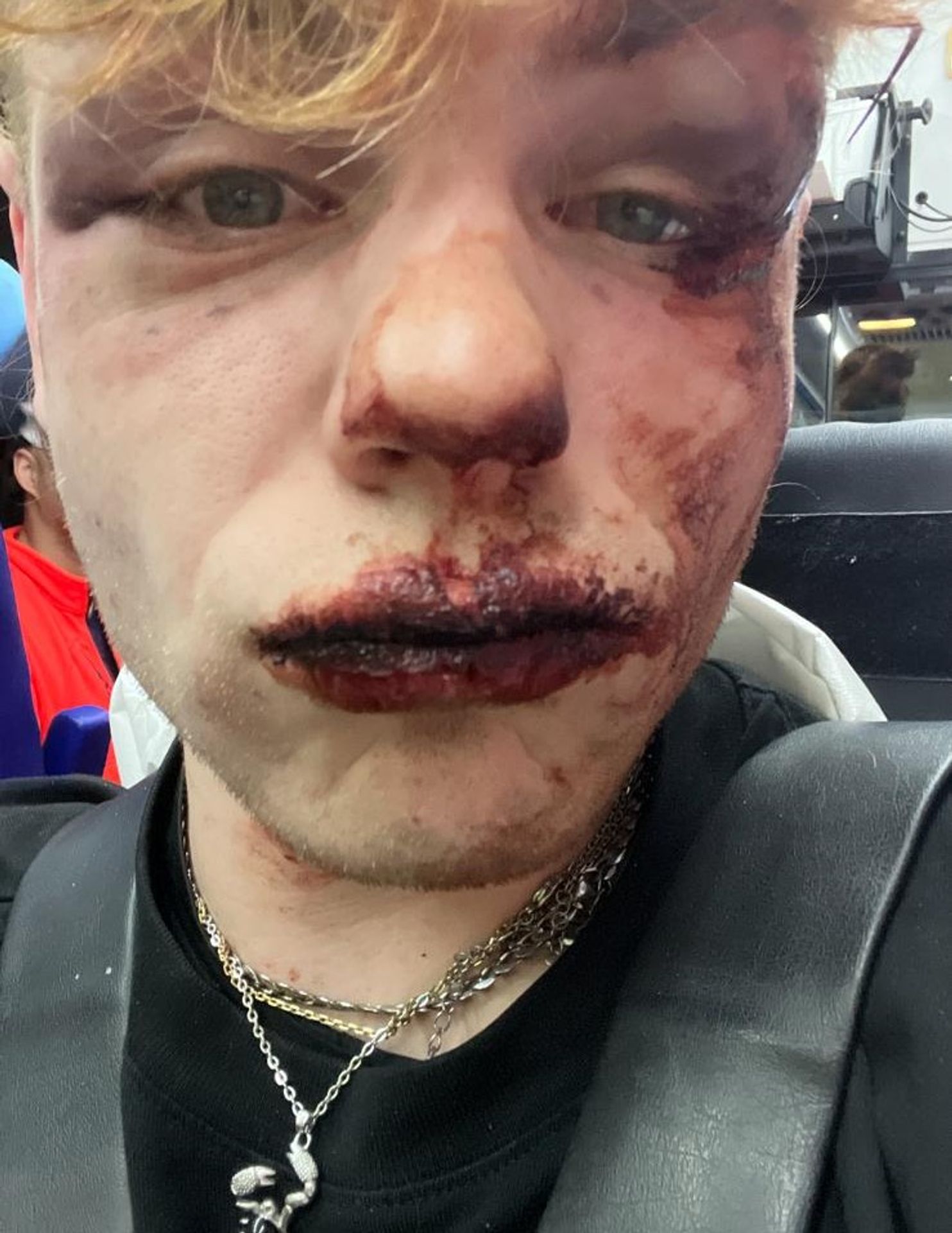 Oskar Hubáček - Oskar Hubáček po incidentu v brněnské čajovně (4/5)