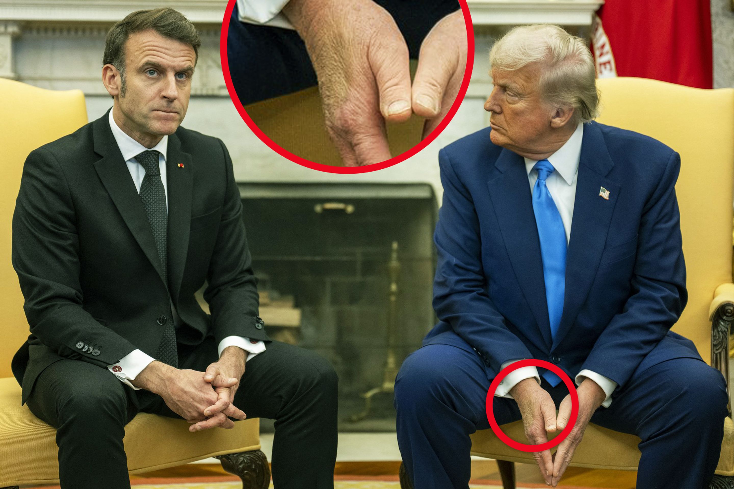 Donald Trump a Emmanuel Macron, 24. 2. 2025 (1) - Donald Trump s modřinou na ruce (2/5)